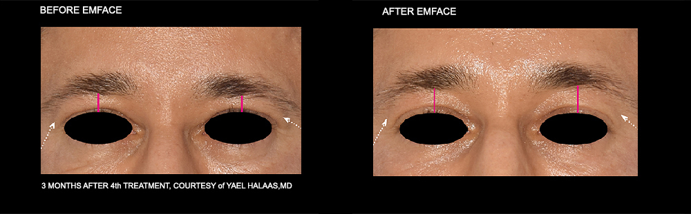 EMFACE Before and After Treatment of the brow area. Courtesy of Yael Halaas, MD