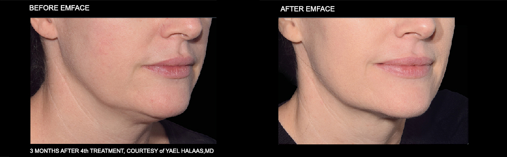 EMFACE Before and After Treatment of the jawline. Courtesy of Yael Halaas, MD