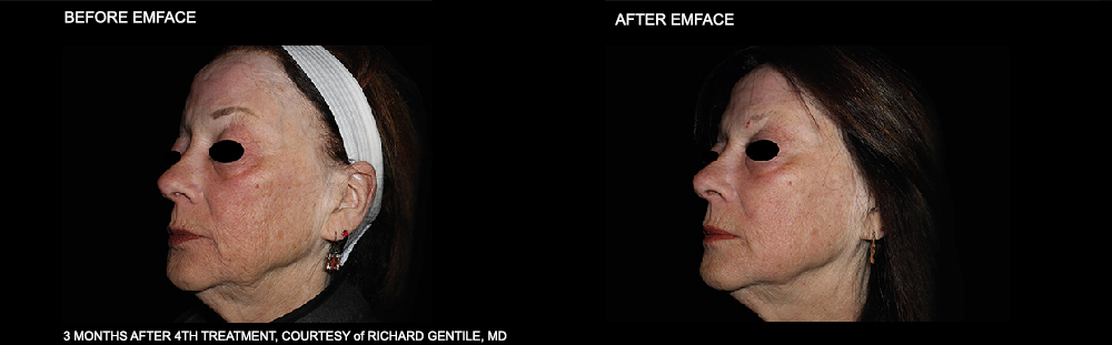 EMFACE Before and After Treatment of the face. Courtesy of Richard Gentile, MD