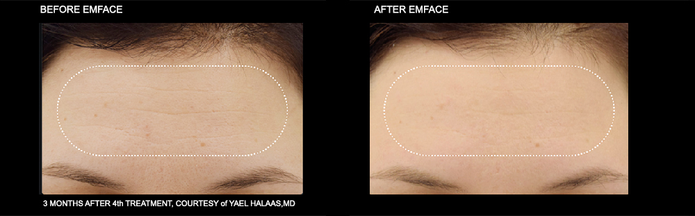EMFACE Before and After Treatment of the forehead. Courtesy of Yael Halaas, MD