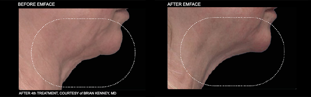 EMFACE Before and After Treatment of the neck. Courtesy of Brian Kenney, MD